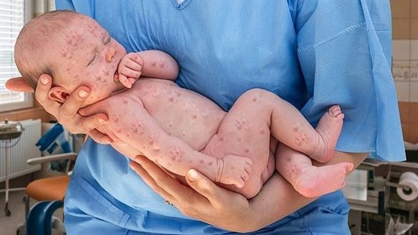 كندا تسجل وفاة رضيع