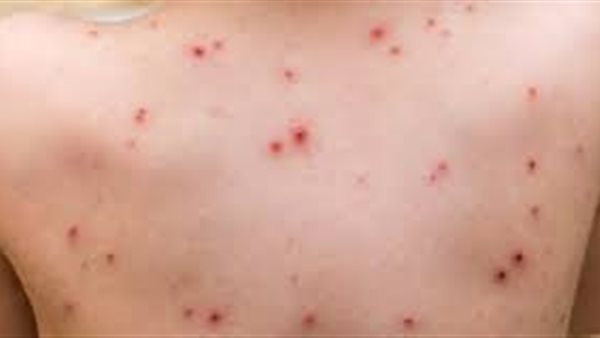 جدري القرود