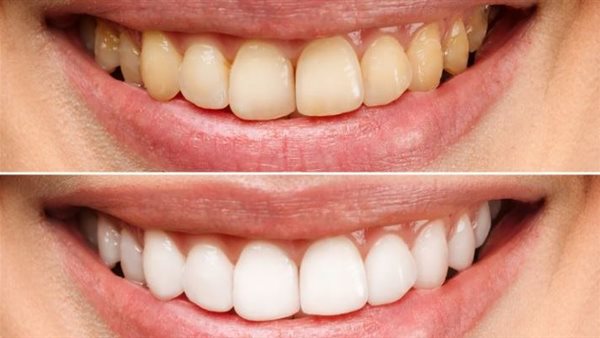 تبييض الأسنان 