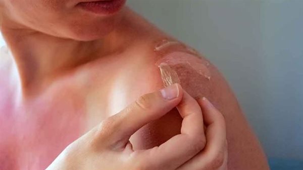  حروق الشمس في فصل