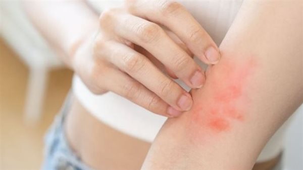 ظهور التينيا