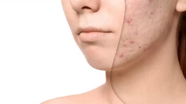 الندبات وحفر الوجه