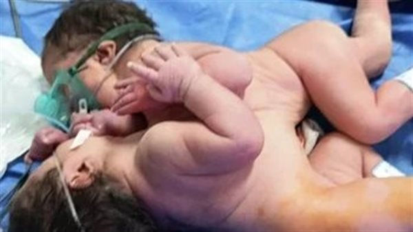 الاطفال المولودة