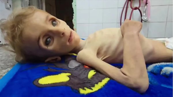 وفاة طفلة بسبب سوء