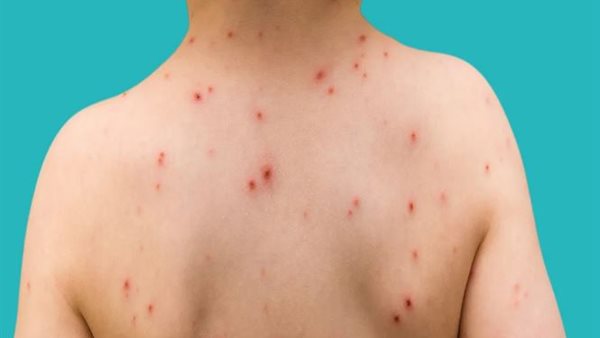 الجدري الطفولي