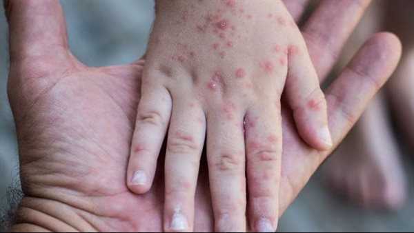 جدرى مائى- ارشيفيه