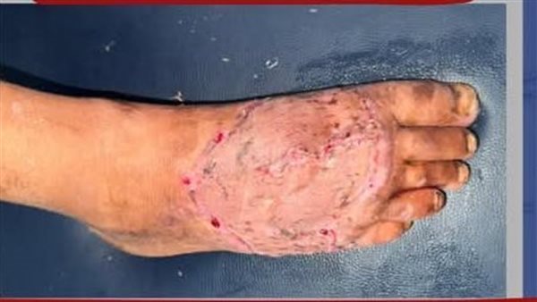 القدم المصابة