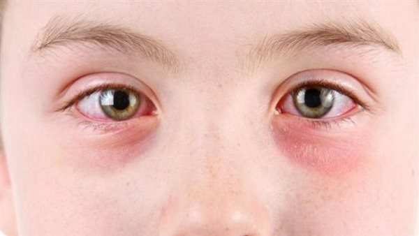 مرض التراكوما