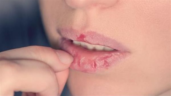 جفاف الشفاه 