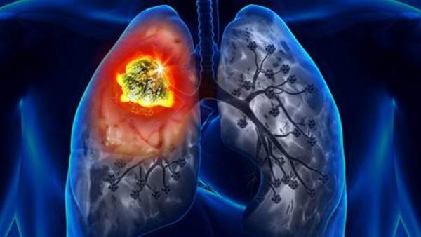 سرطان الرئة 