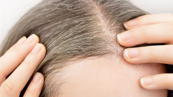 الشيب المبكر