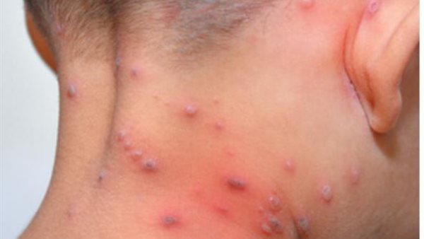 الجديري المائي