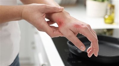 حروق المطبخ 